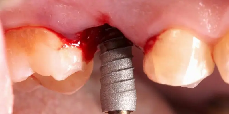 Un implant posé dans un secteur postérieur, le lambeau encore ouvert